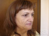 Подтяжка лица - до и после операции