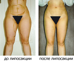 Липосакция - до и после операции